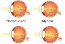 Refractive Errors Image